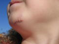 Kira's stitches